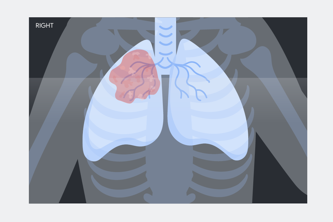 chest x-ray graphic